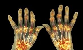 Qual è la differenza tra l'artrite dovuta all'osteoartrite delle articolazioni