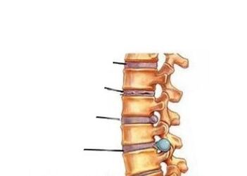 Quattro fasi di sviluppo nell'osteocondosi